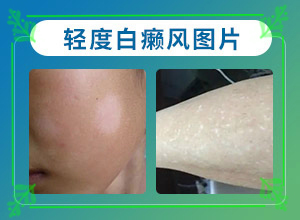 [有哪些方法可以緩解]白殿風(fēng)長在臉上好治嗎