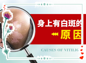 白巔峰的早期特征,如何知道白斑是否為白癜風(fēng)(怎么診斷鑒別)