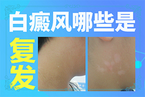 早期白瘋癲癥狀圖片,又有哪些癥狀表現(xiàn)呢(剛發(fā)現(xiàn)該怎么辦)