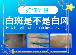 白癲治療效果[哪些具體療法]白癜風患者吃什么食物