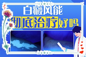 [醫(yī)治白斑有什么竅門]哪個治療白癲好