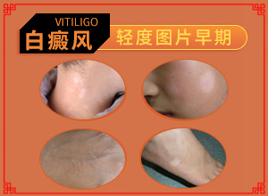 治療白癲瘋醫(yī)院,科學(xué)正確治療方法(應(yīng)該如何)