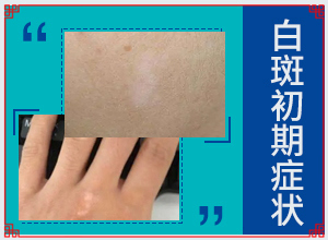 白點(diǎn)癲風(fēng)長什么樣子,如何診斷正確的呢(如何辨別)