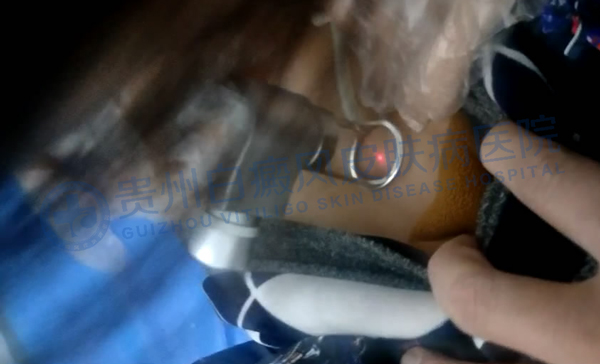 二氧化碳激光治療機治療