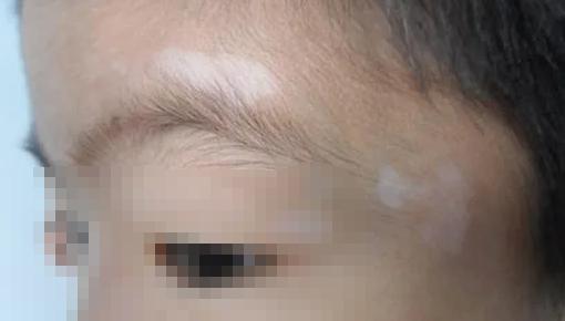 小孩身上有白斑怎么辦？