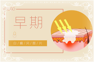 白點(diǎn)風(fēng)病情發(fā)作后白斑癥狀，你了解了嗎