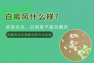 頸部白癩風(fēng)發(fā)作的因素，原來是生活中容易忽視的細(xì)節(jié)