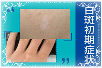 惠水縣白點風(fēng)不能吃什么-多吃什么-科學(xué)的飲食有益病情恢復(fù)