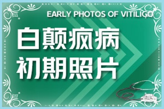 務(wù)川縣白癩風(fēng)初期醫(yī)治方法-三個要點需謹(jǐn)記-復(fù)色好
