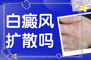 小孩子臉上有小白斑用什么藥可以治療(怎么治療比較好)