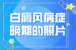 小孩入秋臉上長(zhǎng)白斑是怎么回事,得白癜風(fēng)的概率(何種原因呢)