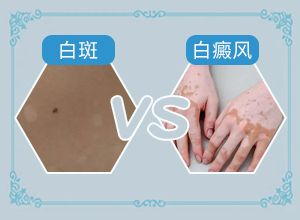 白癲風(fēng)會(huì)有什么癥狀[都有哪些癥狀]身體出現(xiàn)白班怎么辦