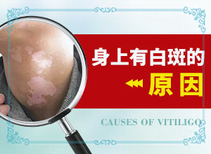 白癲瘋出起癥狀的圖片,怎么能看出長啥樣的(征兆有哪些)