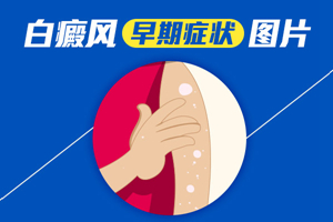 [速度看]早期白癜風(fēng)的癥狀是什么樣子的-我們可以通過什么判斷識(shí)別早期的白癜風(fēng)