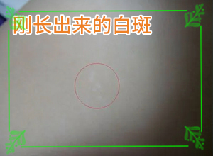 皮膚上長了白色的小點(diǎn)-患上了會(huì)出現(xiàn)哪些癥狀