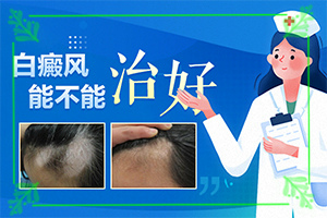 嘴巴上面有點白斑是什么情況-發(fā)生因素有哪些