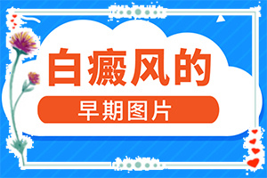 白癩風(fēng)圖片初期[主要的癥狀是什么]白殿病初期癥狀圖片