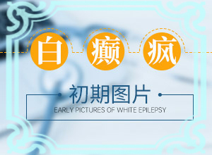 白癩風(fēng)是什么原因產(chǎn)生的-腿上和胳膊上有白斑是什么原因