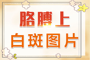 肚子有蟲臉上白斑圖片-泛發(fā)型白癜風(fēng)癥狀特征