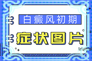 白癲瘋要如何治療[什么方法控制住]專業(yè)治療臉上白癜風(fēng)醫(yī)院