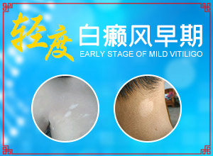 人的身上有白斑怎么辦,哪些癥狀需要注意(不同時(shí)期是什么癥狀)