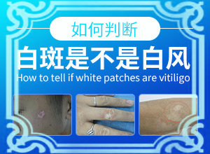 孩子生下來屁股上就有一塊白斑,病情加重是因?yàn)槭裁?啥原因呢)
