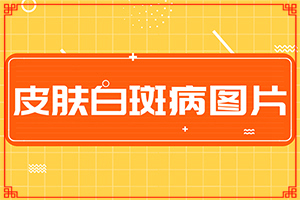 白癲治療醫(yī)院那里最好[治白斑怎么治好得快]兒童白癩風能治好嗎
