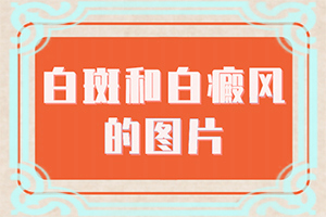 小腿長白班是什么原因[怎樣判斷癥狀]白殿風初期癥狀和圖片
