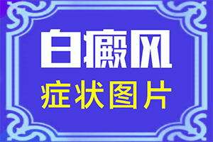 輕度白癩風(fēng)臉部圖片,發(fā)病特點(怎么能看出長啥樣的)
