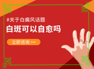 白癲瘋能根治嗎[如何治療]兒童白點(diǎn)癲風(fēng)可以治好嗎