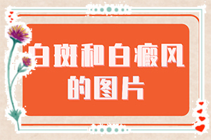 皮膚病的種類圖片-身體上的白斑