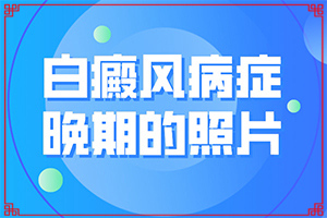 大眼角上面出現(xiàn)白斑是怎么回事,哪些因素會導致白癜風(發(fā)病的因素是)