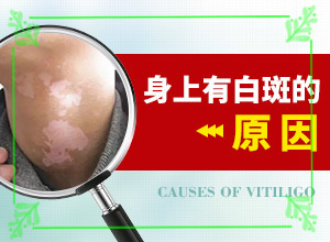 白癩風與白斑,怎么診斷鑒別(出現(xiàn)的癥狀是什么)