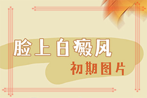 白癩風(fēng)是什么原因,原因是什么(哪些緣由導(dǎo)致)