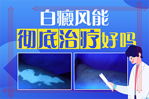 嘴角有一塊白斑一年了還沒好怎么辦(需要什么樣的治療)