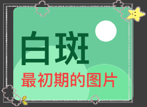 兒童臉上有白斑怎么回事-什么原因會(huì)誘導(dǎo)白斑