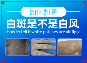 皮膚有塊白斑[都有哪些表現(xiàn)]白血癥有哪些癥狀