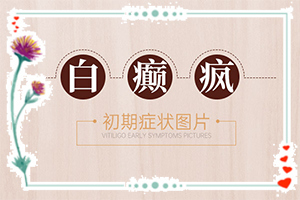 白癲瘋怎么治療好？[怎么治療比較好]兒童白癩癜風(fēng)能嗎