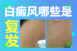 脖子上有白色斑塊是什么原因-病因有哪些呢