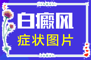 眼角出現(xiàn)白斑-白點(diǎn)癲風(fēng)有什么癥狀圖