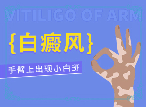 [治療后可以恢復嗎中年女性白班病怎么治療