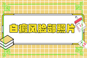 得白癜風的概率-孕婦患有白癜風會遺傳給胎兒嘛