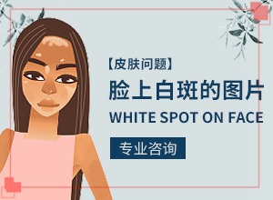 太陽(yáng)爆曬后出現(xiàn)的白斑能治愈嗎,發(fā)病的因素是(為什么患上)