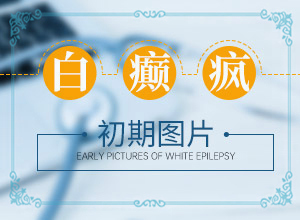 白癩風(fēng)與白斑[怎么診斷鑒別]臉上有白班是怎么回事