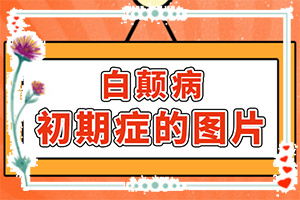 白瘋顛怎么得的,哪些會(huì)誘發(fā)呢(哪些誘發(fā)因素)