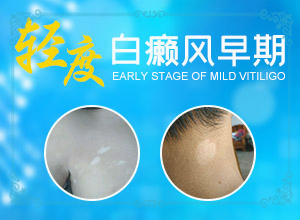 外傷引起瞳孔白斑能治療好嗎。,常見誘因有哪些(發(fā)生因素有哪些)