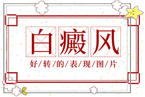 手上得白斑是怎么回事-白斑病發(fā)的原因