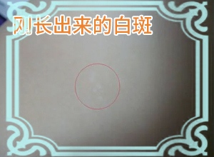 白班用什么藥涂[如何才能診療]腰部的白殿風(fēng)好治療嗎?