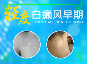 白巔峰的治療方法-[推薦閱讀]白斑治療進(jìn)展分析