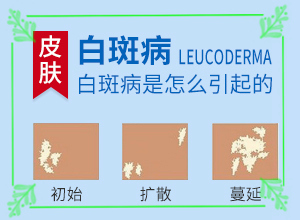 白點癲風(fēng)好治療嗎[治療效果怎么樣]治療兒童癲方法